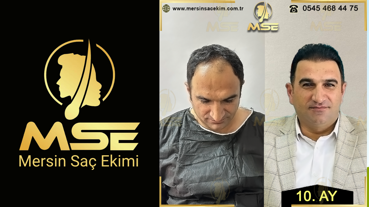 MERSİN SAÇ EKİMİ